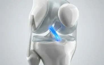 Cirugía de Ligamento Cruzado Anterior